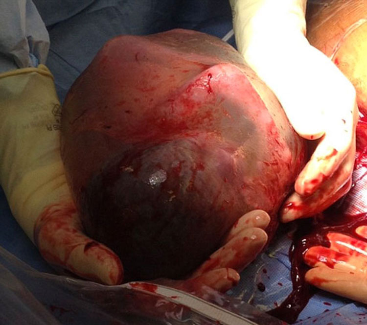Milagro Médico: Bebé Prematuro Nace Dentro Del Saco Amniótico