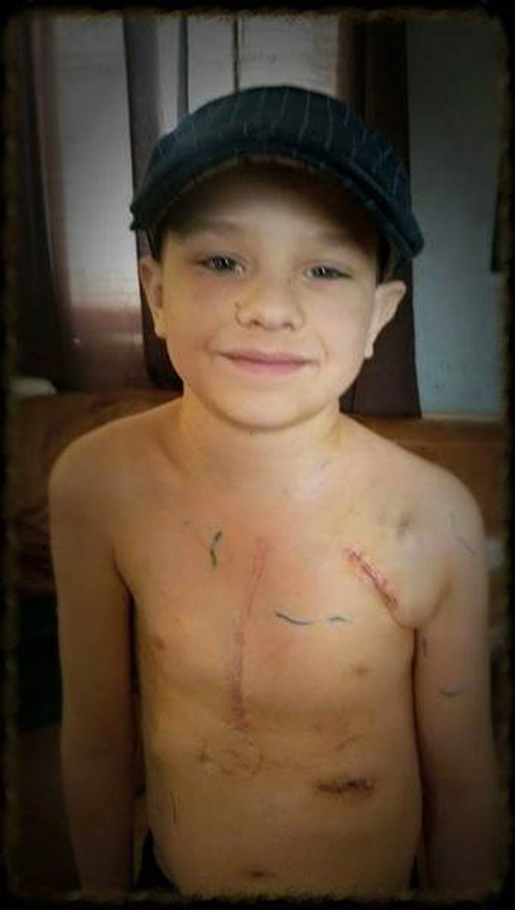 "Las cicatrices son hermosas": foto viral de un padre ayuda a curar la ANGUSTIA de las cicatrices de su hijo 1