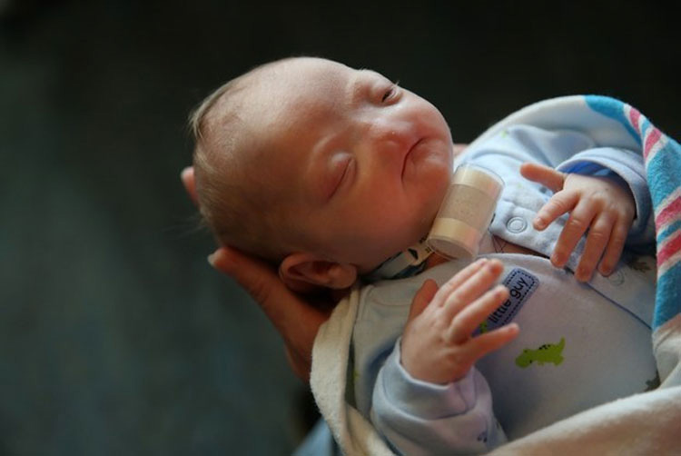 Conozca al adorable bebé que nació sin nariz y que es toda una sensación en Internet
