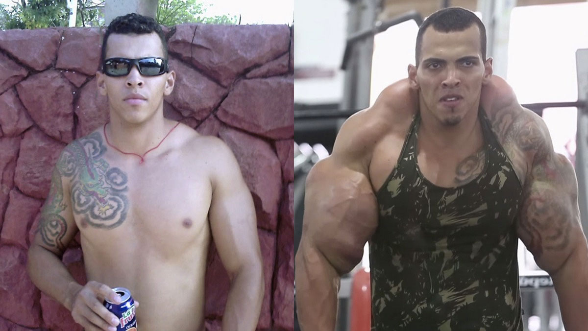 El "Hulk" de la vida real casi forzado a tener que AMPUTARLE los brazos