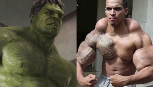 El "Hulk" de la vida real casi forzado a tener que AMPUTARLE los brazos