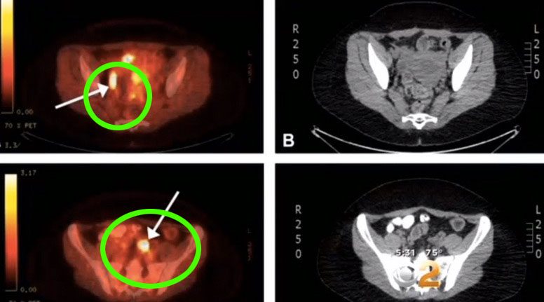 Le dijeron que su cáncer se había extendido, pero lo que los médicos descubrieron les dejo en SHOCK