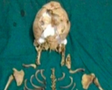 Un esqueleto de bebé muerto de 36 años de edad se encuentra dentro de una mujer india