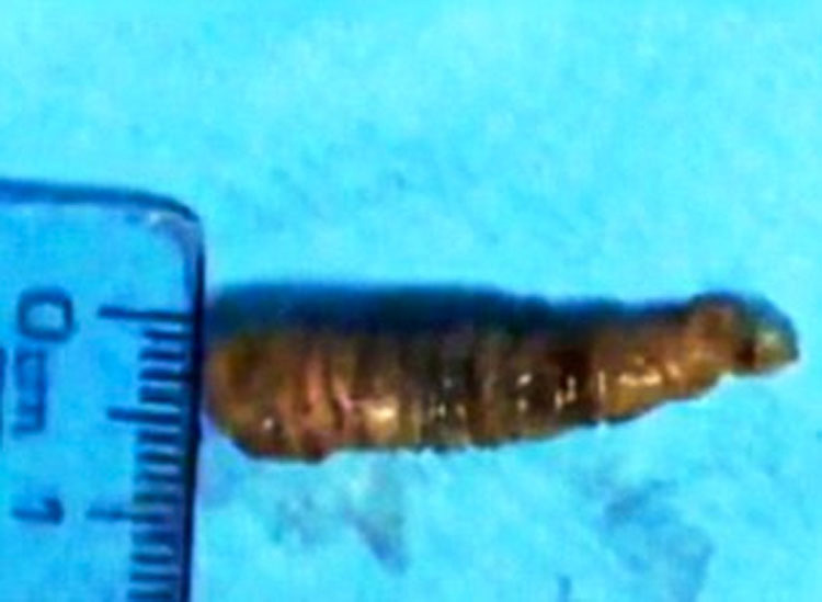 IMPACTANTE vídeo que muestra el gusano vivo de 3cm que tenía un adolescente en su ojo, llevaba ahí un mes