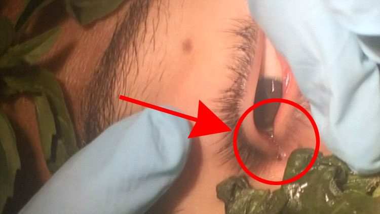 IMPACTANTE vídeo que muestra el gusano vivo de 3cm que tenía un adolescente en su ojo, llevaba ahí un mes