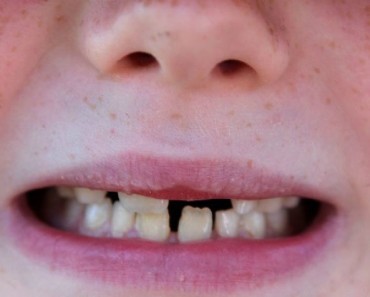No podía CREER lo que oía cuando el dentista le dice lo que causó la caries dental de su hijo