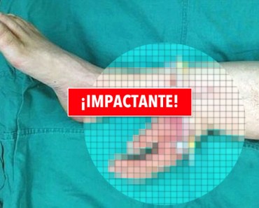 Mano cortada de un hombre es injertada en la pierna durante un mes antes de que se la coloquen de nuevo