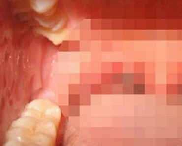 Esta mujer sufría de mal aliento. Y no era porque era no usara la pasta de dientes, era causado por piedras de la amígdala.