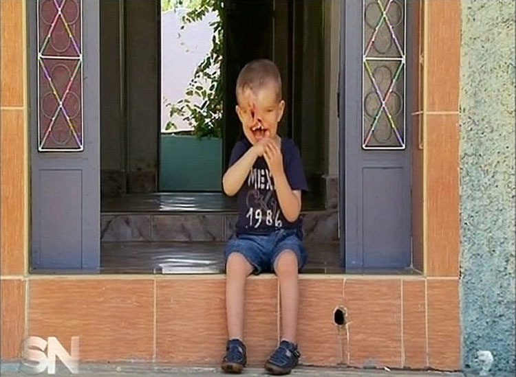 Este niño se sometió a 18 horas de cirugía para tener una segunda oportunidad en la vida. Debes verlo cómo es ahora...