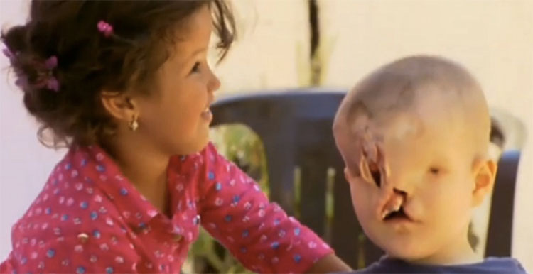 Este niño se sometió a 18 horas de cirugía para tener una segunda oportunidad en la vida. Debes verlo cómo es ahora...