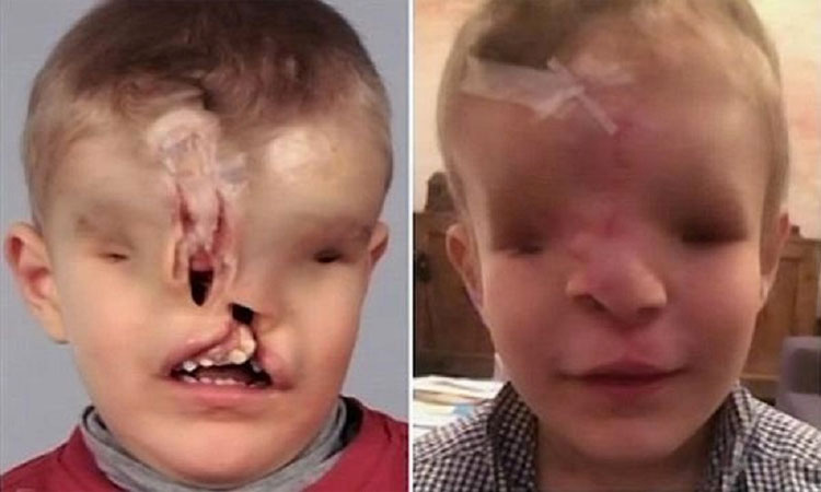 Este niño se sometió a 18 horas de cirugía para tener una segunda oportunidad en la vida. Debes verlo cómo es ahora...