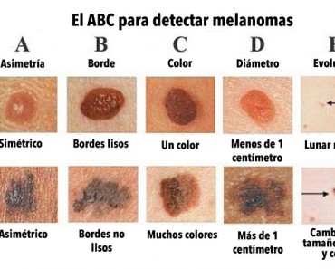 ¿Conoces la diferencia entre un lunar normal y uno CANCEROSO? Este gráfico podría salvar tu vida 2