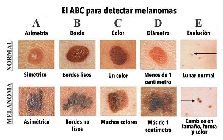 ¿Conoces la diferencia entre un lunar normal y uno CANCEROSO? Este gráfico podría salvar su vida