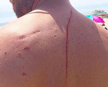 Este hombre tuvo que ir al hospital tras el ataque de un tiburón y descubrieron algo que le salvó la vida