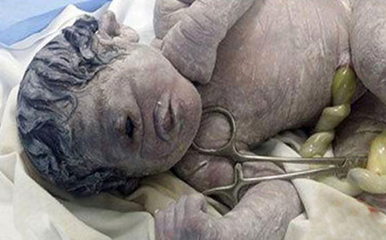 Este bebé con defectos extremadamente raros ha nacido con un solo ojo en medio de la frente 1 Este bebé con defectos extremadamente raros ha nacido con un solo ojo en medio de la frente