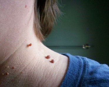 Verrugas de la piel: qué son y cómo deshacerse de ellas 8 Verrugas de la piel: qué son y cómo deshacerse de ellas