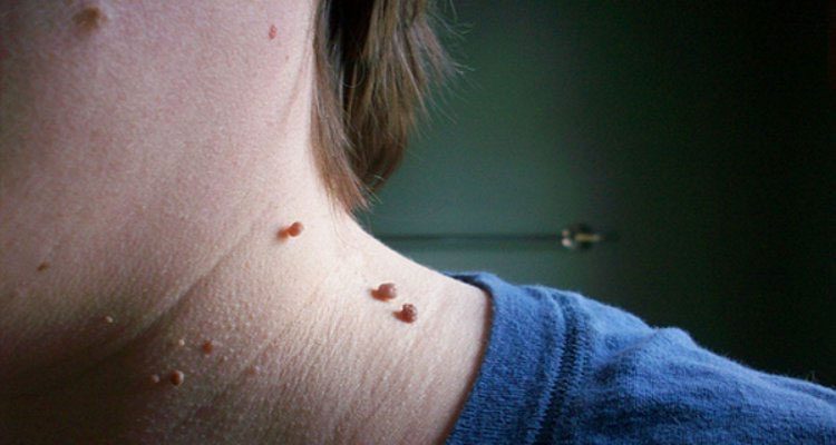 Verrugas de la piel: qué son y cómo deshacerse de ellas