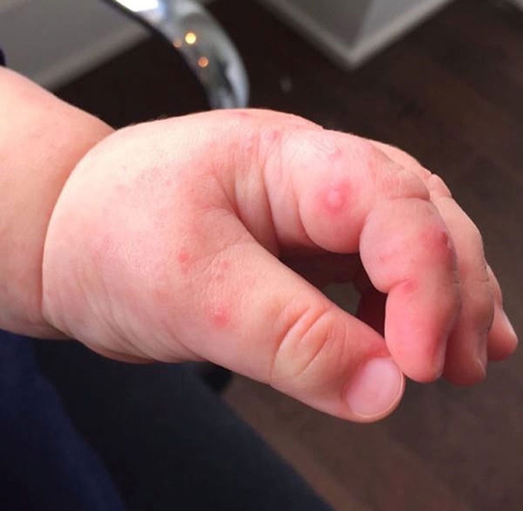 Esta madre nota una ampolla en la mano de su bebé, pero nunca esperó que los médicos dijeran esto...