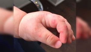 Esta madre nota una ampolla en la mano de su bebé, pero nunca esperó que los médicos dijeran esto...