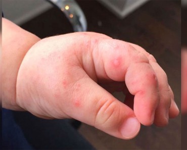 Esta madre nota una ampolla en la mano de su bebé, pero nunca esperó que los médicos dijeran esto... 8 Esta madre nota una ampolla en la mano de su bebé, pero nunca esperó que los médicos dijeran esto...