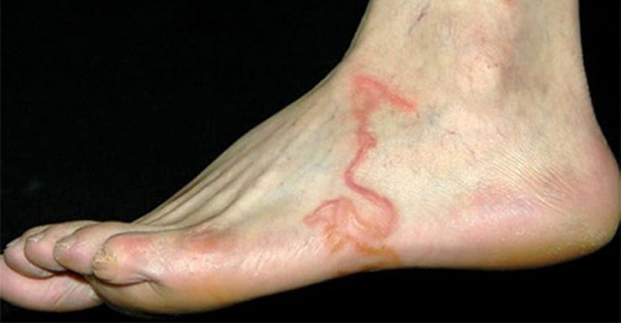 Pensaba que esto era sólo una vena, hasta que sus médicos descubrieron la horrible verdad 4 Pensaba que esto era sólo una vena, hasta que sus médicos descubrieron la horrible verdad