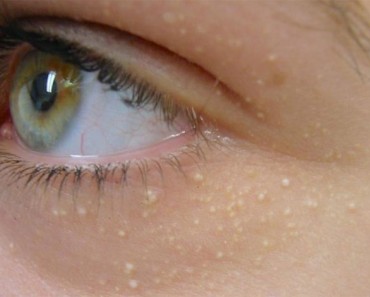 Estas manchas blancas alrededor de tu ojo pueden tener un aspecto inocente, pero significan algo serio