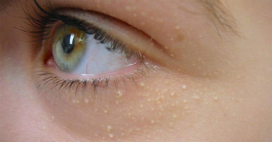 Estas manchas blancas alrededor de tu ojo pueden tener un aspecto inocente, pero significan algo serio