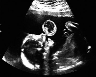 Cree que su bebé está soplando una burbuja durante la ecografía. Entonces ve el rostro de su doctor ... 1 Cree que su bebé está soplando una burbuja durante la ecografía. Entonces ve el rostro de su doctor ...