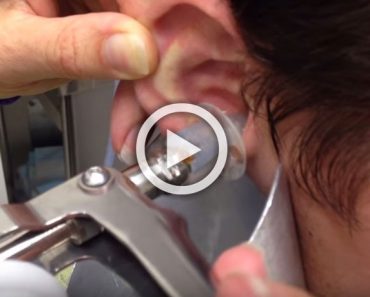 El doctor comienza a bombear agua en su oído, lo que sale casi lo hizo gritar. AVISO: Impactante 6 El doctor comienza a bombear agua en su oído, lo que sale casi lo hizo gritar. AVISO: Impactante