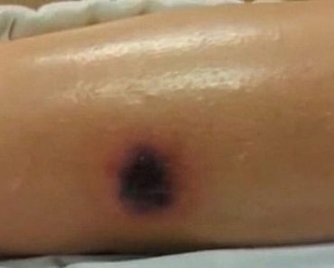 Niño muere 2 semanas después de que su madre encontrase esta marca negra en su pierna