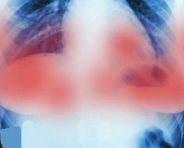 Científicos de Ámsterdam logran destruir tumores de cáncer de mama en 11 días y sin quimioterapia
