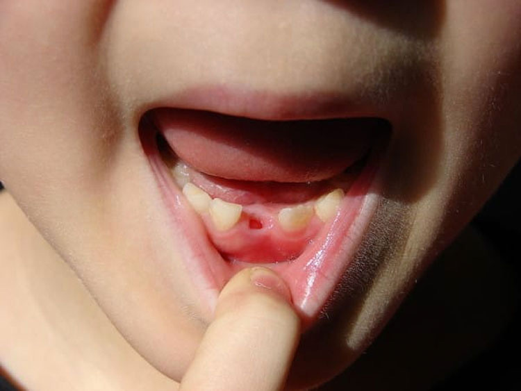 Los médicos instan a todos los padres para que guarden los dientes de leche de sus hijos