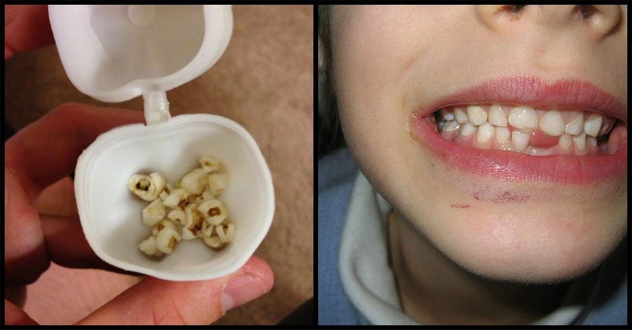 Los médicos instan a todos los padres para que guarden los dientes de leche de sus hijos