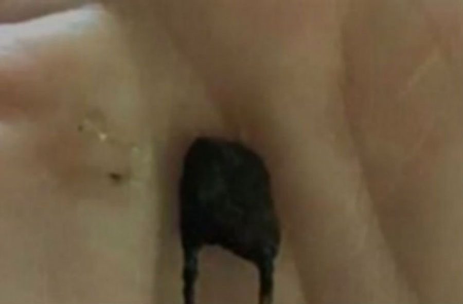 Durante meses se quejó que le dolía la nariz sin conocer la razón. Al final lo vieron 6 Durante meses se quejó que le dolía la nariz sin conocer la razón. Al final lo vieron