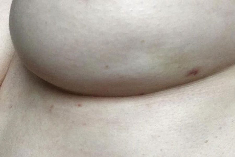 Esta importante imagen comparte un síntoma de cáncer de mama que debes conocer 4 Esta importante imagen comparte un síntoma de cáncer de mama que debes conocer