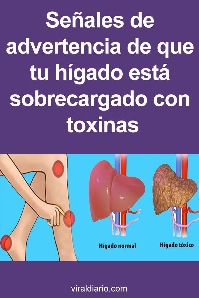 Señales de advertencia de que tu hígado está sobrecargado con toxinas