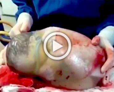 Enfermera filma el raro momento en que un bebé nace dentro de un saco amniótico intacto