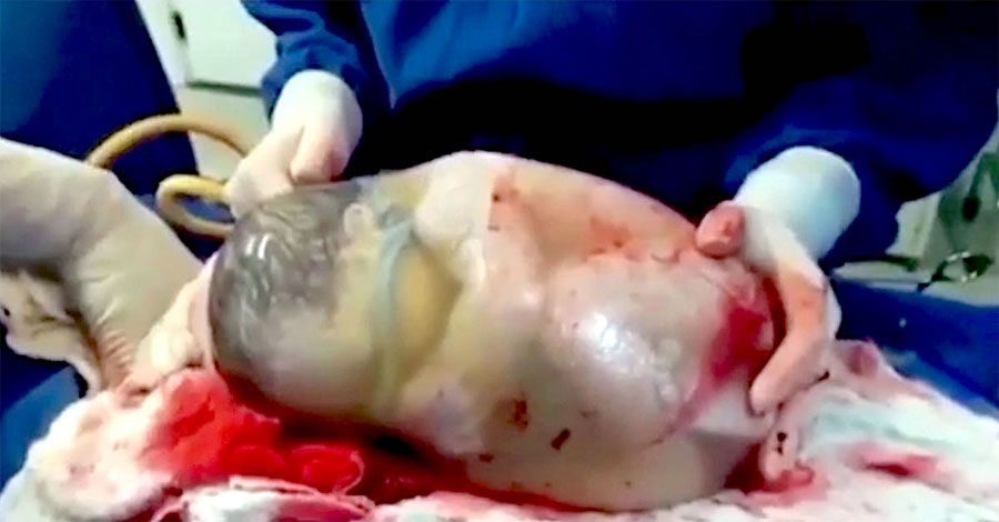 Enfermera filma el raro momento en que un bebé nace dentro de un saco amniótico intacto