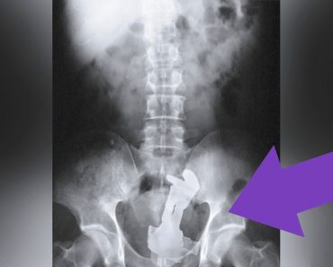 22 objetos que algunas personas se introdujeron en el... cuerpo 1 22 objetos que algunas personas se introdujeron en el... cuerpo