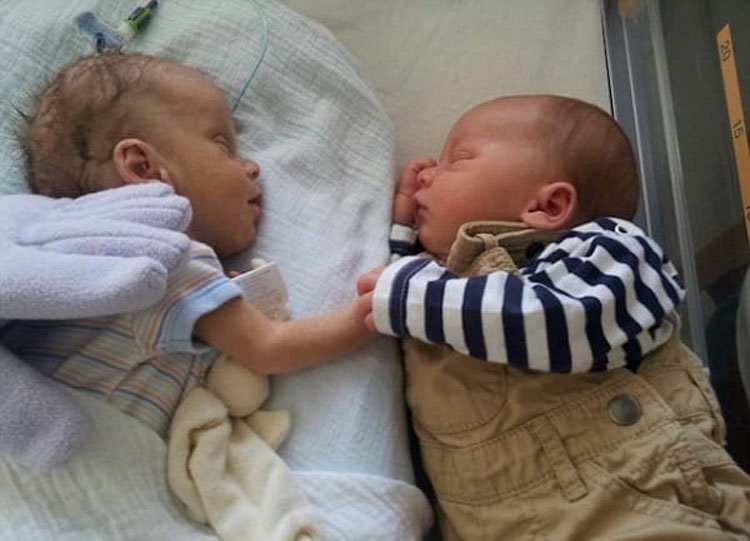 Este recién nacido sufre convulsiones y hemorragias cerebrales, hasta que ponen a su hermano gemelo en su incubadora