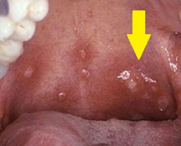 Niña de 10 años muere después de que los médicos diagnosticaran incorrectamente herpes labial en la boca 1 Niña de 10 años muere después de que los médicos diagnosticaran incorrectamente herpes labial en la boca